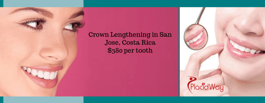 Crown Lengthening in San Jose, Costa Rica Cost